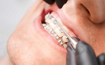 Consejos y cuidados durante el tratamiento de brackets