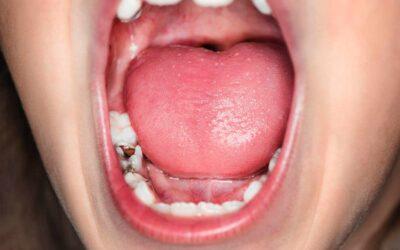 ¿Qué es la mordida abierta?