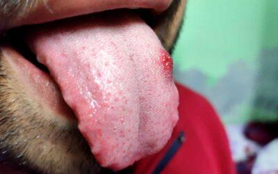 ¿Qué es la candidiasis oral? Síntomas y tratamiento