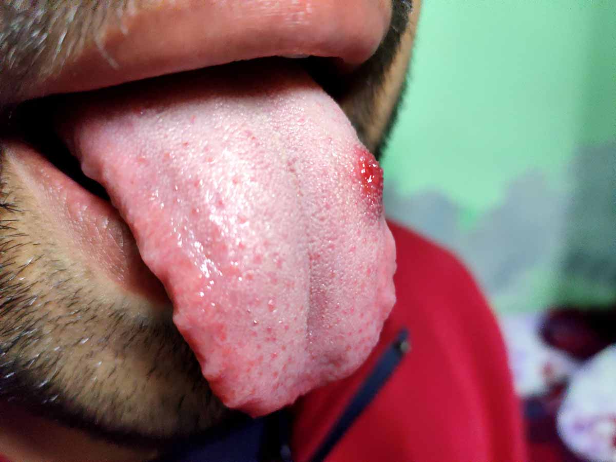 candidiasis-oral-tratamiento-dentista