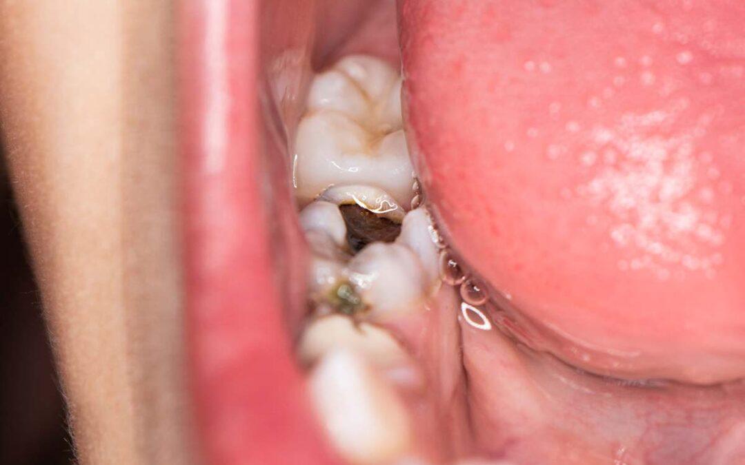 ¿Qué es la muela del juicio?