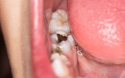 ¿Qué es la muela del juicio?