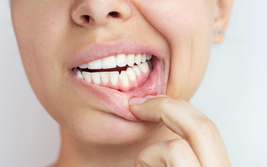 Gingivitis en Vitoria: síntomas, causas y cómo tratarla antes de que avance