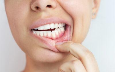 Gingivitis en Vitoria: síntomas, causas y cómo tratarla antes de que avance
