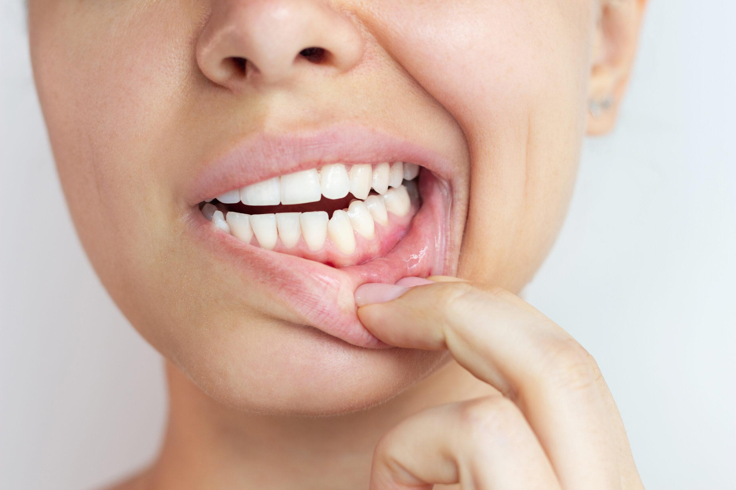 Persona con encías sanas tras tratamiento de gingivitis en clínica Biogasteiz Vitoria